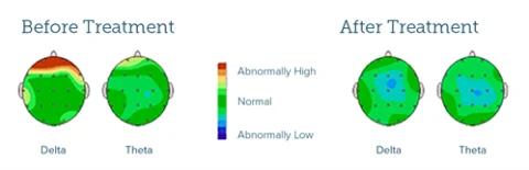 ADHD maps before and after Fig.2