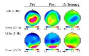 QEEG post therapy assessment